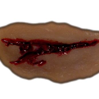 Platzwunde 1